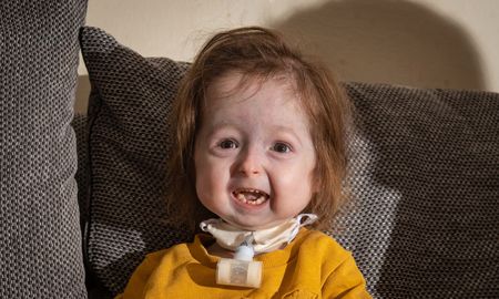 la historia de isla, la nena de dos anos que parece de ochenta por la enfermedad de benjamin button la historia de isla, la nena de dos anos que parece de ochenta por la enfermedad de benjamin button