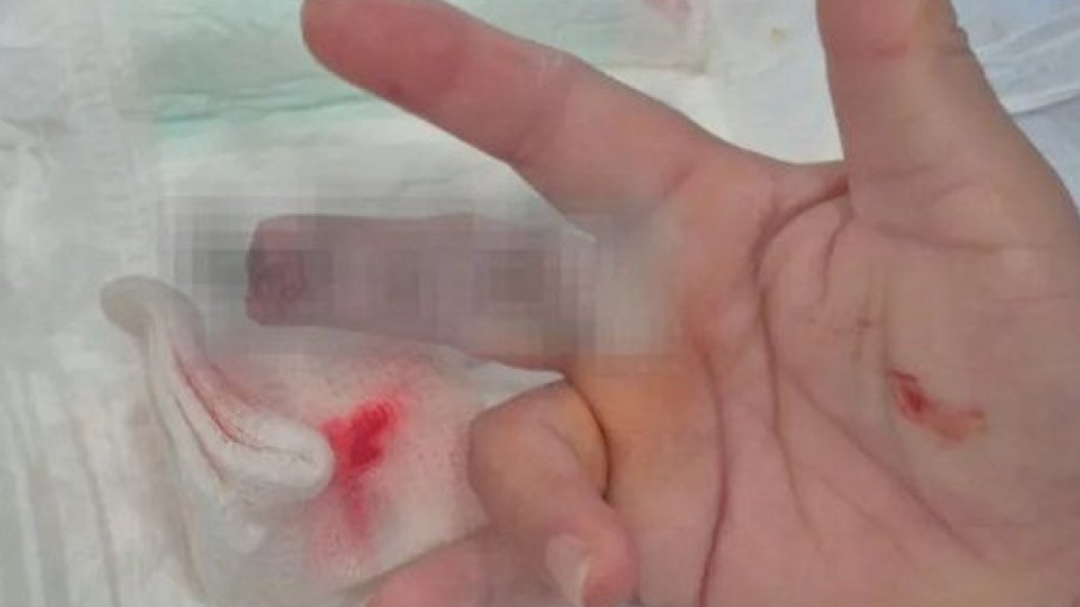 Un episodio de terror tuvo lugar en la provincia del Chaco cuando un paciente atacó brutalmente y le sacó un dedo a una enfermera cuando intentaba asistirlo.