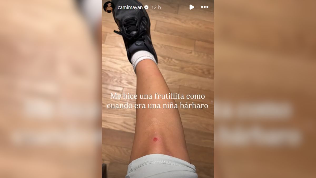 A través de una historia de Instagram, Cami Mayan mostró cómo quedó una de sus rodillas tras la caída. A través de una historia de Instagram, Cami Mayan mostró cómo quedó una de sus rodillas tras la caída.