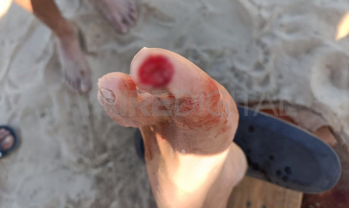 El ataque dejó sin parte del dedo al hombre que se metió al río en la costanera de Coronda.