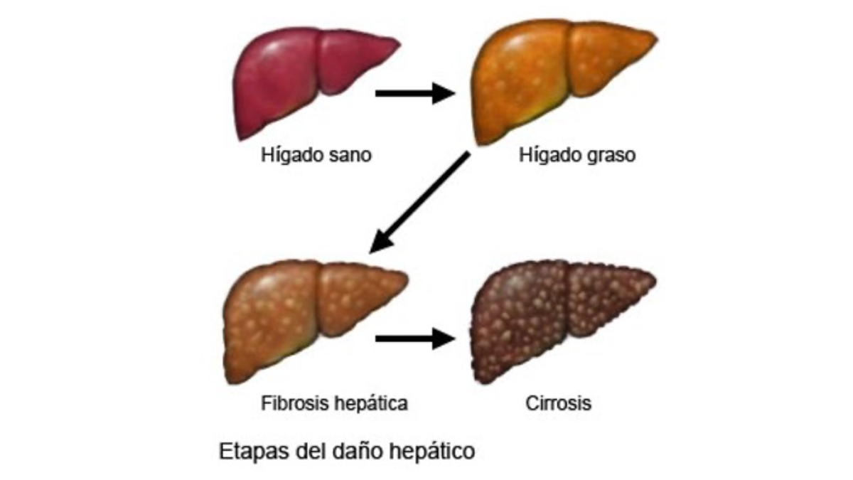 El camino de la enfermedad hepática: la progresión desde un hígado sano hacia la cirrosis es un proceso silencioso que puede revertirse si se detecta a tiempo. El diagnóstico mediante elastografía es la clave para frenar el avance de la fibrosis.