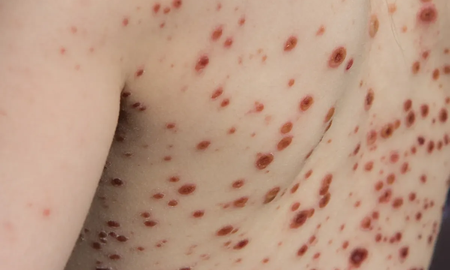 alerta en china por la viruela del mono: implementan estrictos protocolos ante la suba de casos alerta en china por la viruela del mono: implementan estrictos protocolos ante la suba de casos