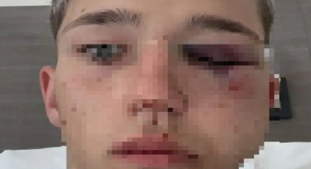 Brutal golpiza de rugbiers a un joven: sufrió 8 fracturas y tiene un ojo comprometido