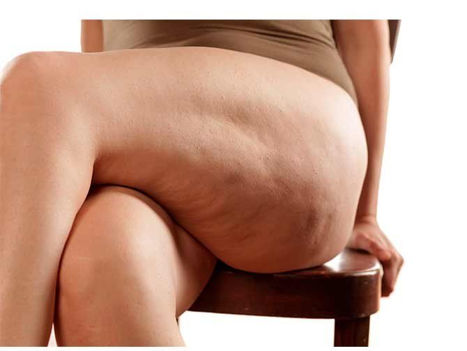 celulitis web 1.jpg
