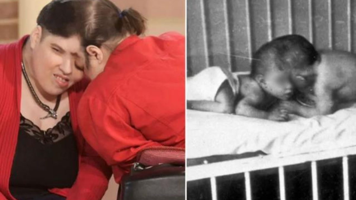 Este domingo murieron los gemelos siameses más longevos del mundo.