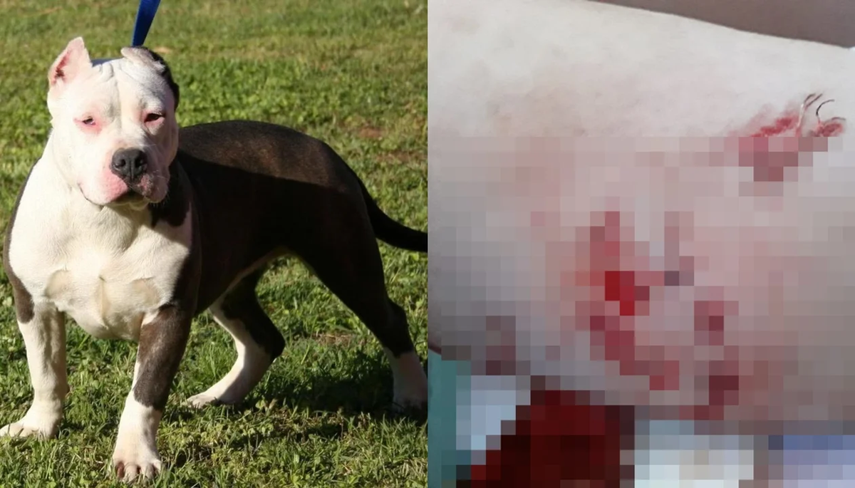 Defendió a su hermanita y fue brutalmente atacada por un pitbull: recibió 72 puntos y camina con ayuda de un andador