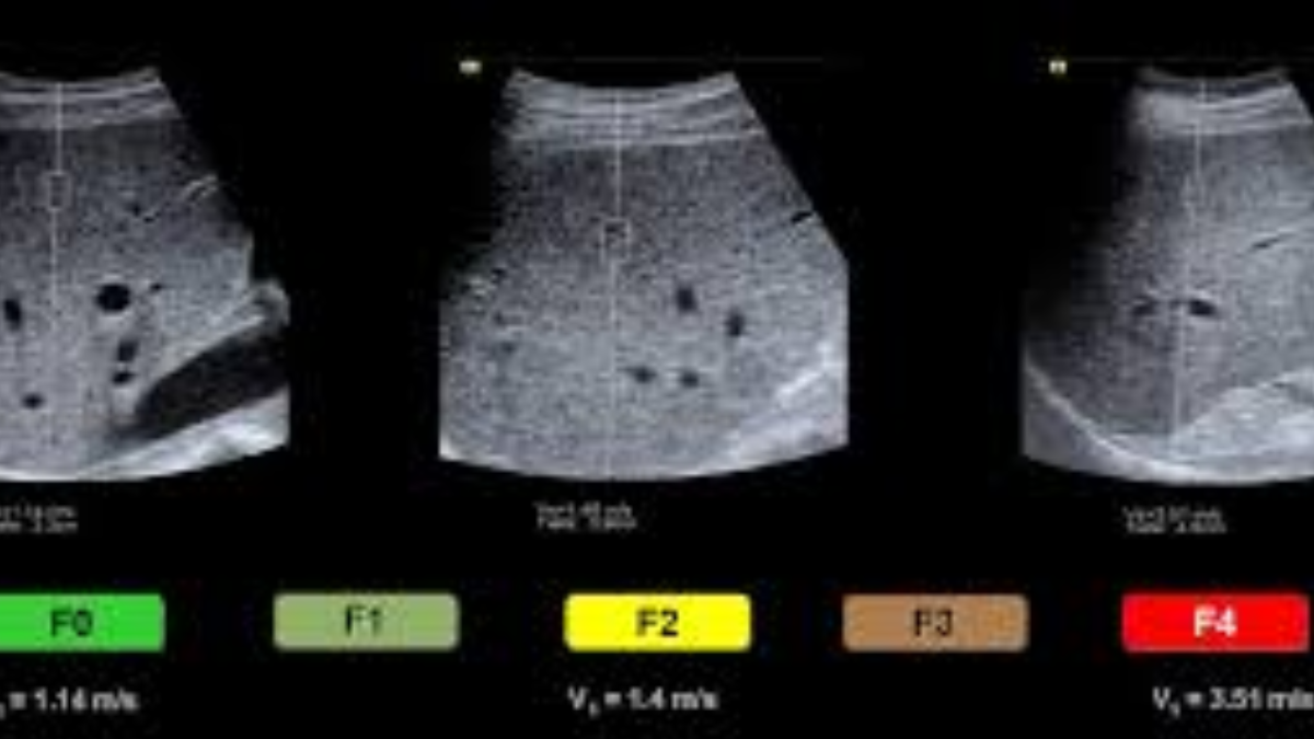 El uso de elastografía shear wave permite evaluar la fibrosis circundante, factor determinante en el riesgo de malignidad. El uso de elastografía shear wave permite evaluar la fibrosis circundante, factor determinante en el riesgo de malignidad.