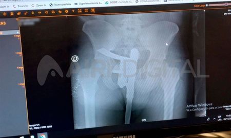 Tuvo un accidente y lo llevaron al Hospital Cullen: tenía un arma de fuego en los genitales.
