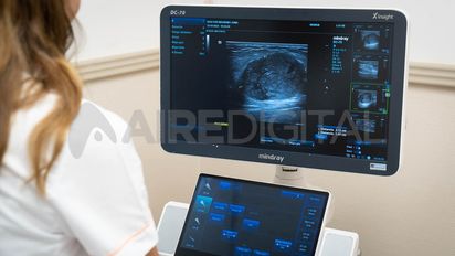 Endometriosis y cáncer de mama: la importancia del diagnóstico temprano en la salud de la mujer