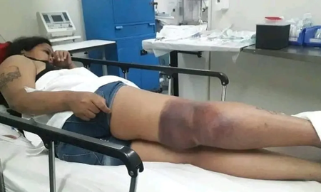 Una joven quiso consultar el saldo de la SUBE y se electrocutó: deberá ser operada Una joven quiso consultar el saldo de la SUBE y se electrocutó: deberá ser operada