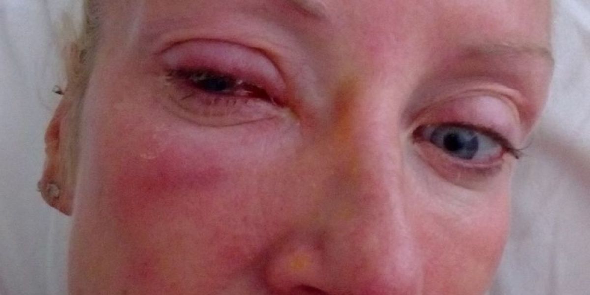 Un parásito se adhirió a su lente de contacto y quedó ciega