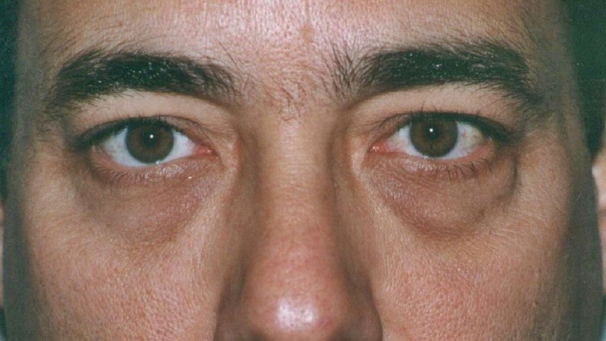 Si bien pueden ser hereditarias, existen múltiples factores para que se desarrollen las ojeras. 