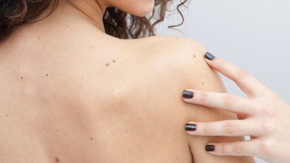 Lunares, colágeno y sol: claves para prevenir riesgos en verano