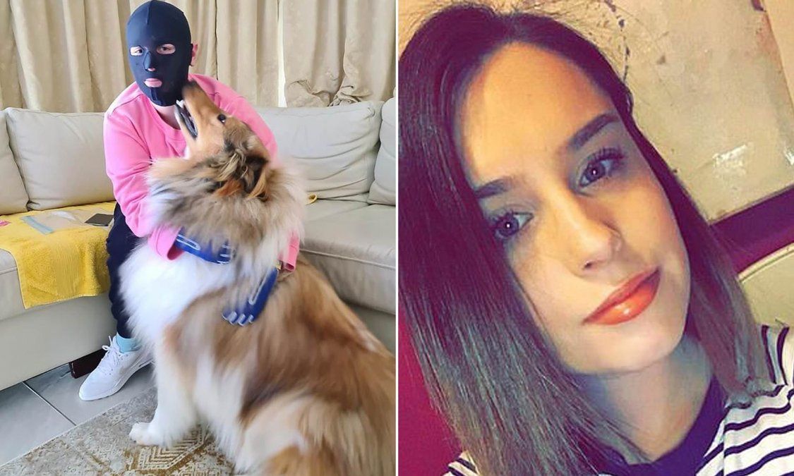 Muestra en Instagram la dolorosa recuperaci&oacute;n tras sobrevivir a la erupci&oacute;n de un volc&aacute;n