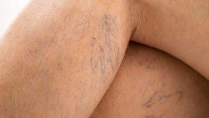 Varices en las piernas: por qué se producen y cómo hay que prevenirlas