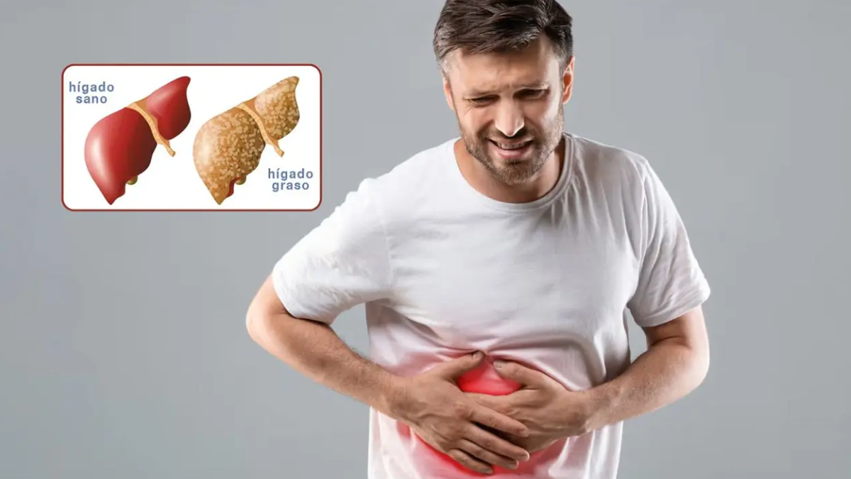 El hígado graso es una enfermedad silenciosa que no suele causar dolor y requiere controles preventivos en pacientes con diabetes o hipertensión.