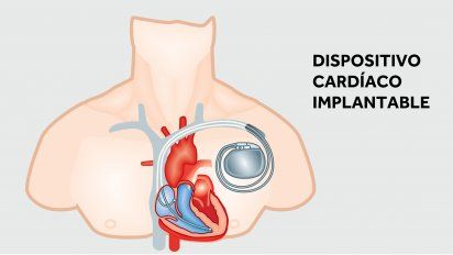 El relato del santafesino que tiene un desfibrilador en el corazón igual al que le colocaron a Christian Eriksen