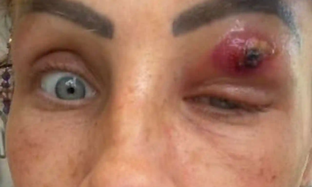 Mujer creyó que tenía un grano en su párpado pero terminó expulsando un parásito Mujer creyó que tenía un grano en su párpado pero terminó expulsando un parásito
