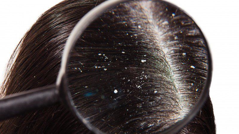 ¿Por qué tenemos caspa en la cabeza?