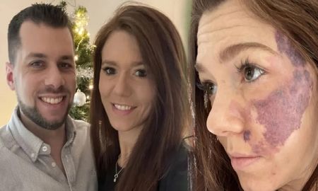 Tiene una mancha de nacimiento en su rostro y su novio nunca se la vio Tiene una mancha de nacimiento en su rostro y su novio nunca se la vio