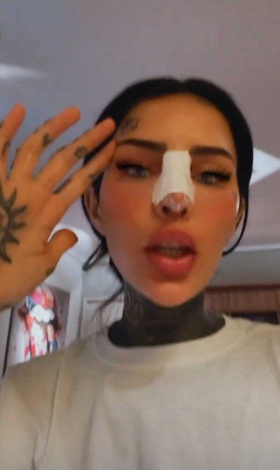 Cande Tinelli mostró el vendaje que le pusieron tras la rinoplastia.