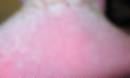 Fue por una erupción en la piel y los médicos le diagnosticaron “sarna altamente contagiosa”.