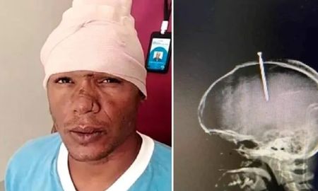 Alucinaba por las drogas y se le incrustó un clavo en la cabeza Alucinaba por las drogas y se le incrustó un clavo en la cabeza