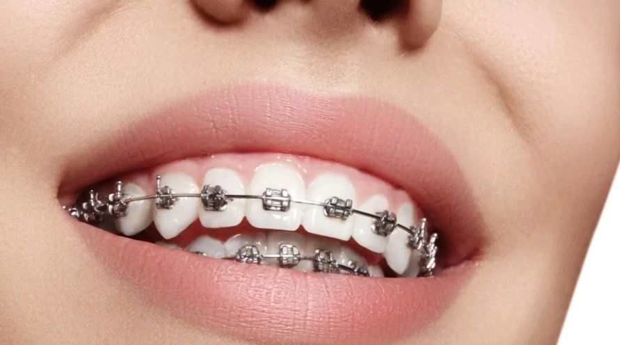 ¿Usás brackets? Ocho consejos fundamentales para cuidar tus dientes