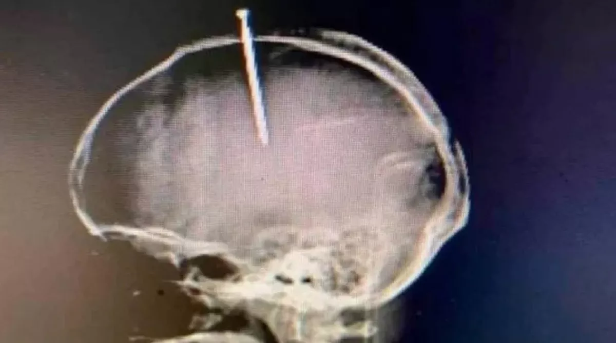 El paciente fue ingresado en un hospital de la ciudad de Santiago, en Rep&uacute;blica Dominicana, con el instrumento de mental hundido en su cabeza.