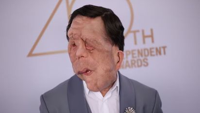 Activismo en los Premios Óscar: la historia de Adam Pearson, el actor que visibiliza la neurofibromatosis