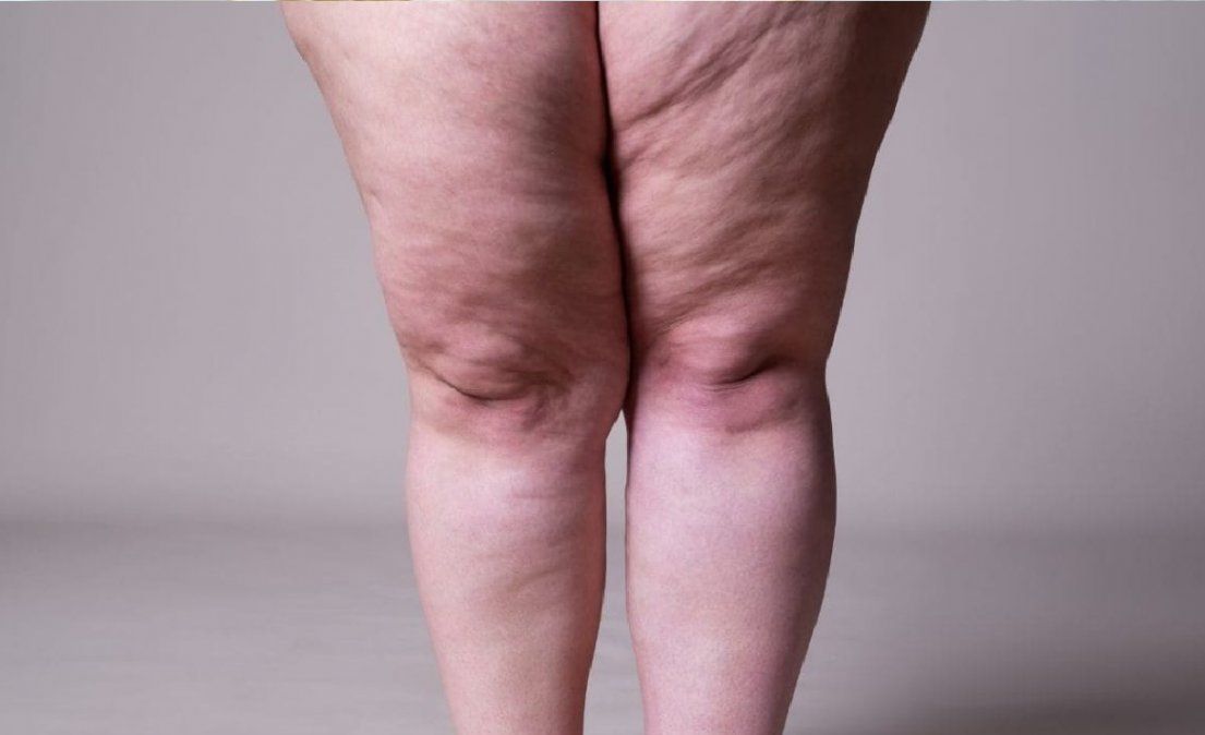 Tips para adelgazar la grasa de las piernas de forma saludable