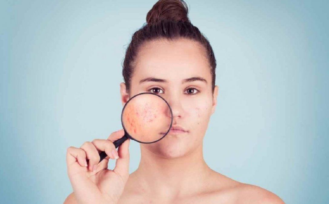 El efecto milagro de los probióticos en el acné