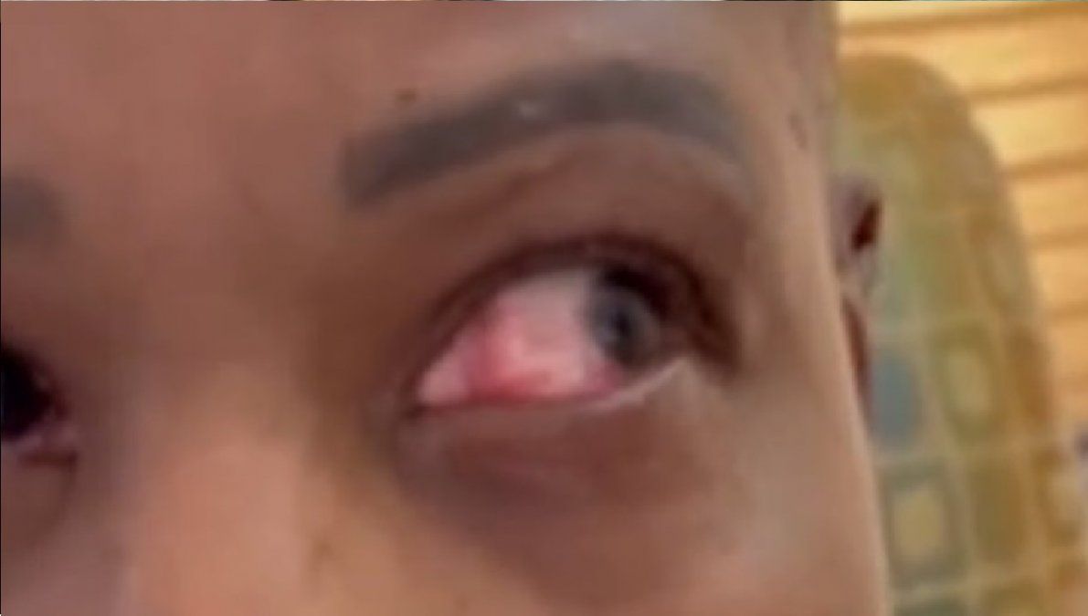 Se puso pegamento en el ojo al confundirse con las gotitas lubricantes