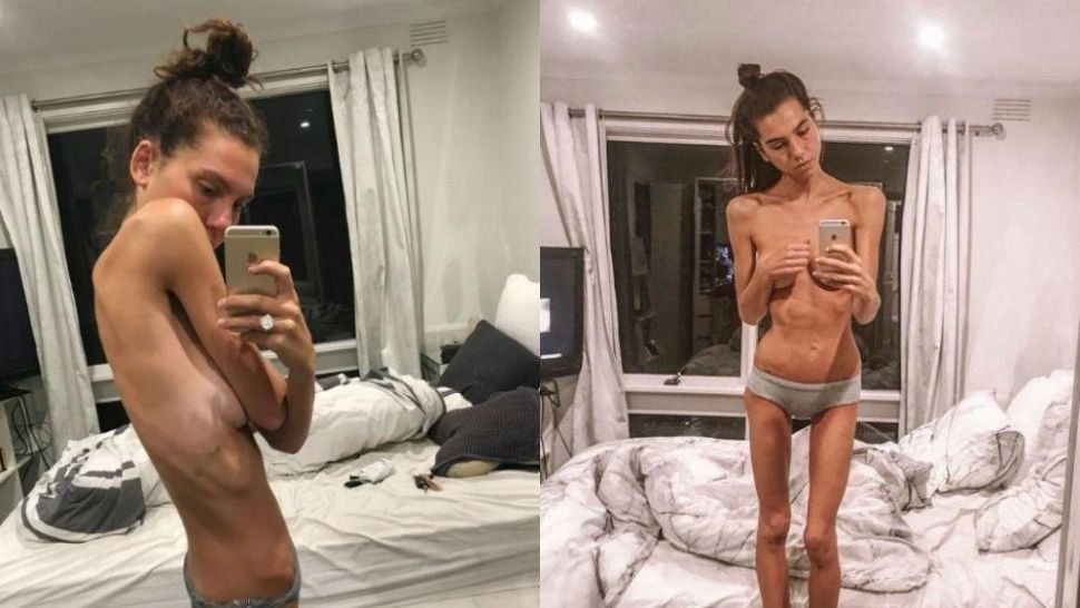 Anorexia.jpg