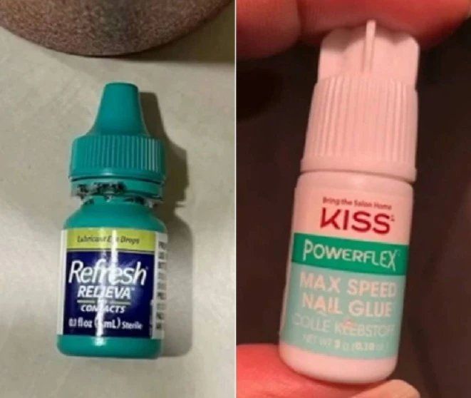 Confundió pegamento con gotas para los ojos.