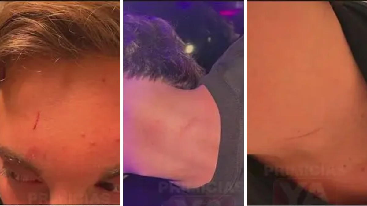 Tras la acusación de la hija de Marcelo Tinelli, el entorno de su expareja difundió imágenes de rasguños en el cuello y la frente para sostener su versión de los hechos. Tras la acusación de la hija de Marcelo Tinelli, el entorno de su expareja difundió imágenes de rasguños en el cuello y la frente para sostener su versión de los hechos.