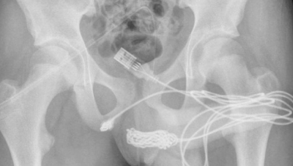 Un chico intentaba medir su miembro y se le enredó un cable USB en la uretra: tuvieron que operarlo&nbsp;