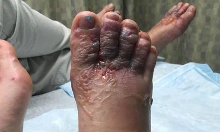 fueron a punta cana y volvieron con un parasito que ?comio? sus pies fueron a punta cana y volvieron con un parasito que ?comio? sus pies