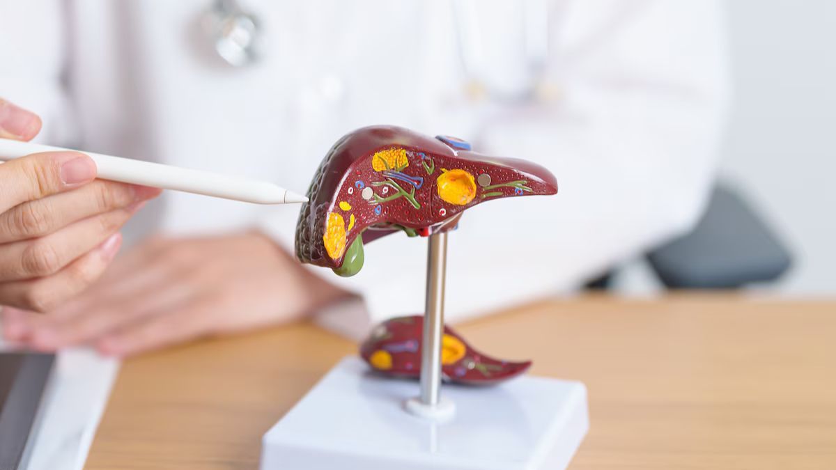 El hígado graso es una enfermedad silenciosa que afecta al 20% de la población. El hígado graso es una enfermedad silenciosa que afecta al 20% de la población. 