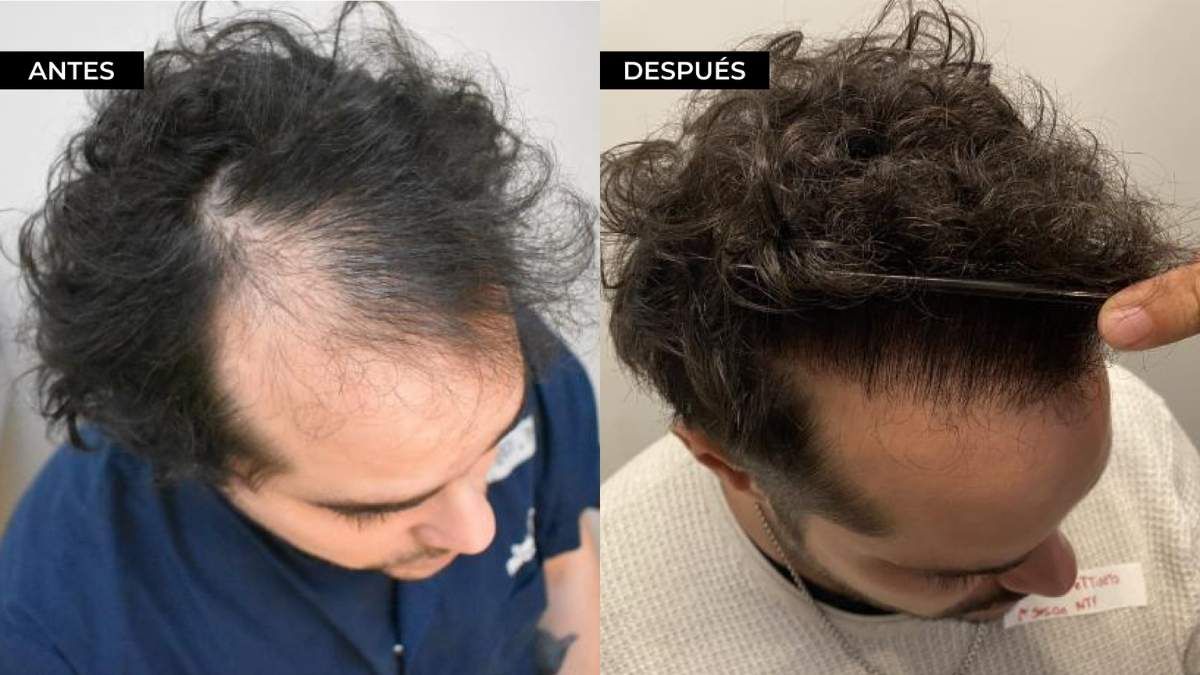 Los resultados del microtrasplante capilar pelo por pelo son sumamente naturales. Los resultados del microtrasplante capilar pelo por pelo son sumamente naturales.