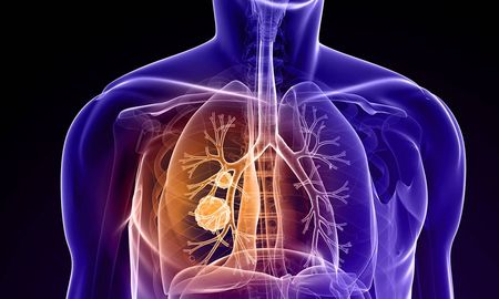 Aire de Santa Fe | Cáncer de pulmón.jpg