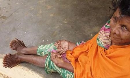 que es la polidactilia, el trastorno genetico que acosa a esta mujer y la transformo en bruja que es la polidactilia, el trastorno genetico que acosa a esta mujer y la transformo en bruja