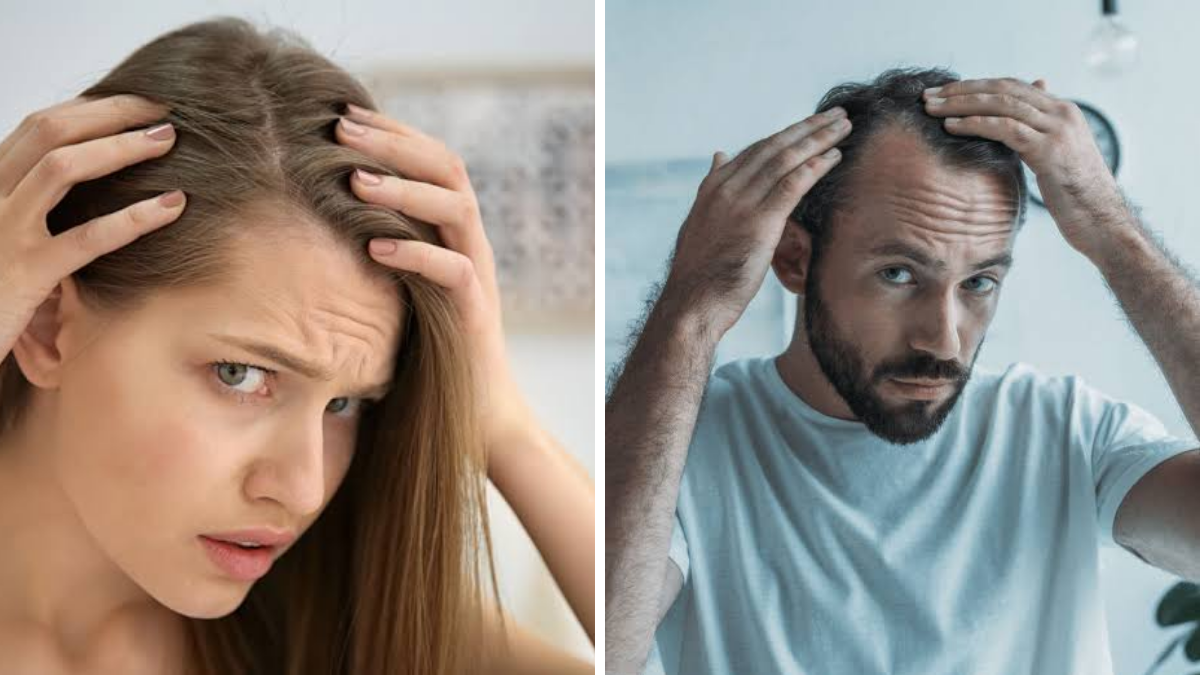 La pérdida de cabello es una de las consultas más frecuentes en dermatología.
