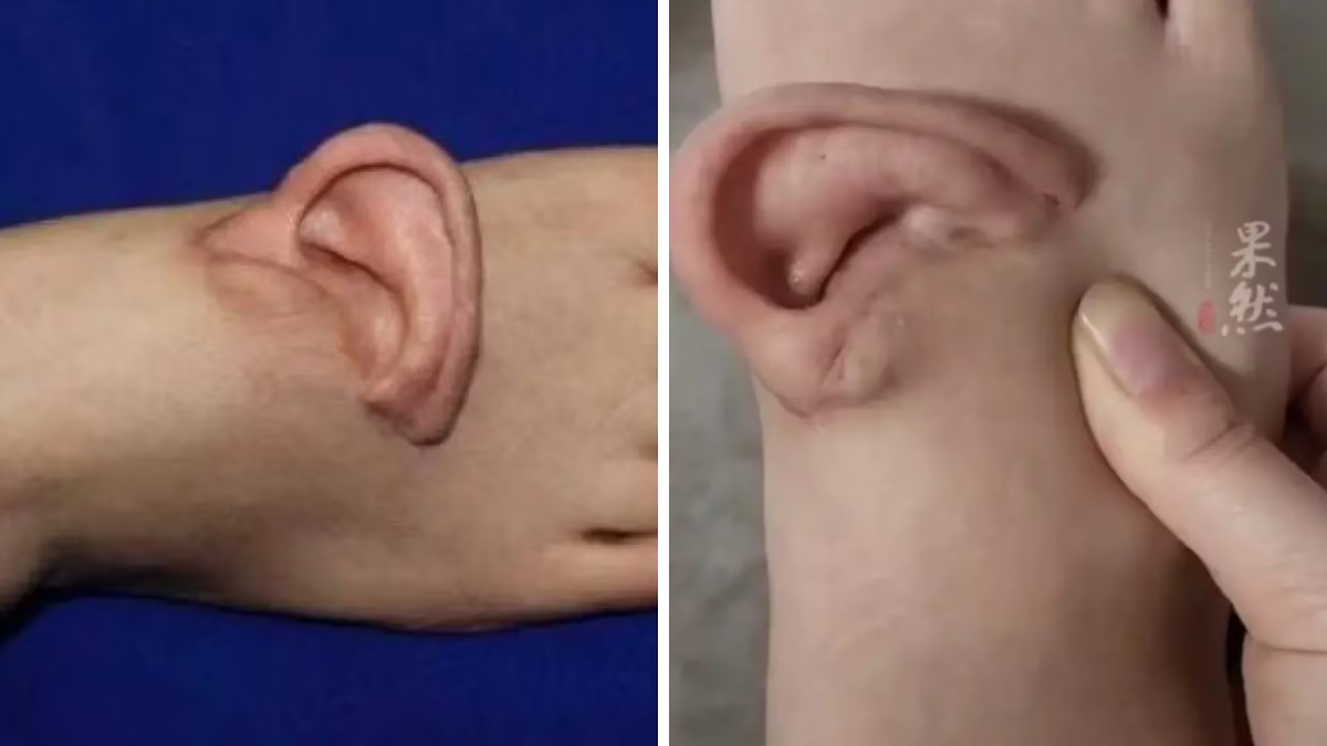 Llevó su oreja implantada en el pie.