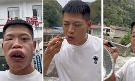 Desfigurado: así terminó un influencer tras comerse una avispa viva Desfigurado: así terminó un influencer tras comerse una avispa viva