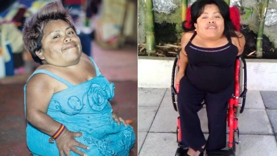 Pasó más de 40 años de diagnósticos errados hasta que le detectaron el Síndrome de Morquio