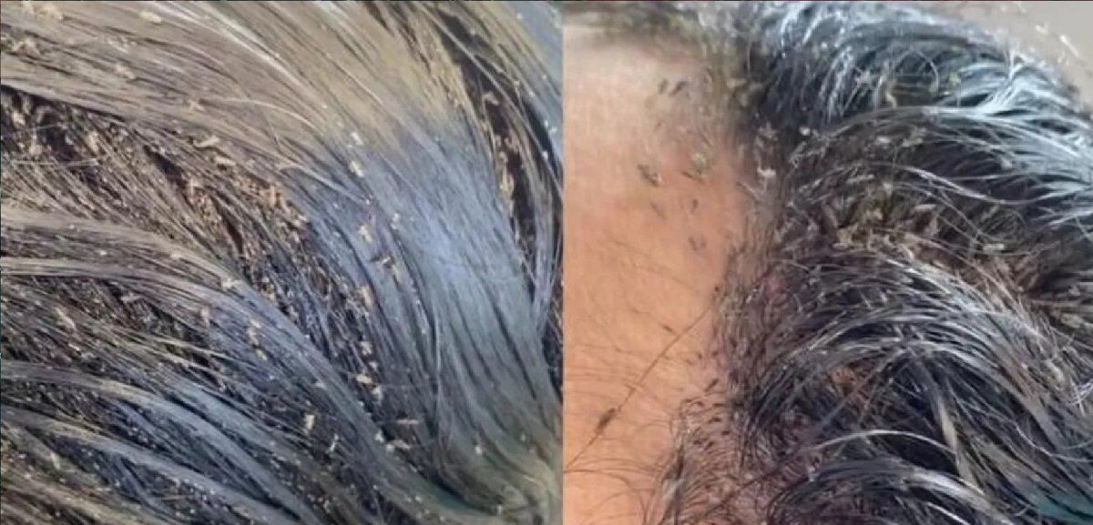 Video escalofriante: la nena que tuvo que ir al hospital porque tenía 15.000 piojos en la cabeza