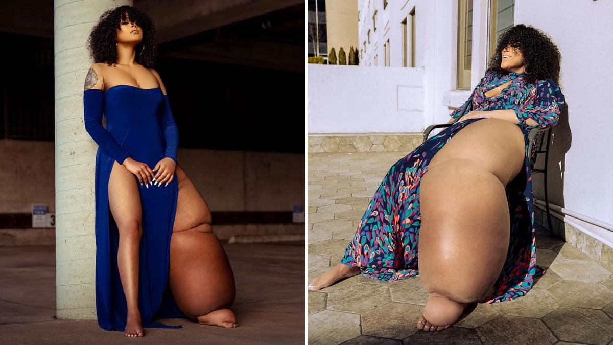 Una influencer con linfedema recibe crueles comentarios sobre su condición: Por qué no te amputas la pierna