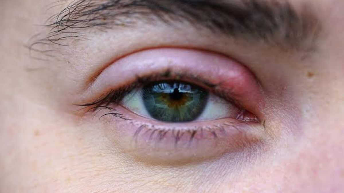El Staphylococcus aureus es la bacteria más común asociada a la inflamación e infección del folículo palpebral.