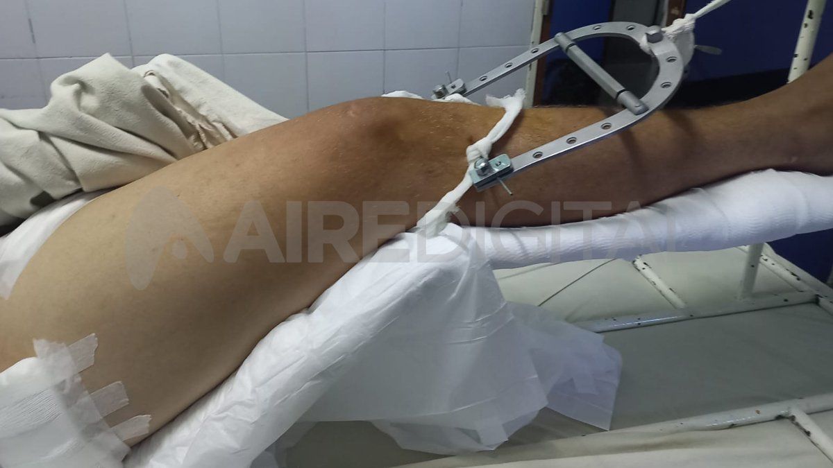 Uno de los jóvenes internados en el Cullen recibió un balazo en el glúteo que le provocó una fractura expuesta.